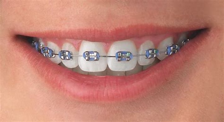 Que son los brackets mini?