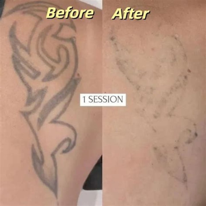 Should I pop a blisters from laser tattoo removal?