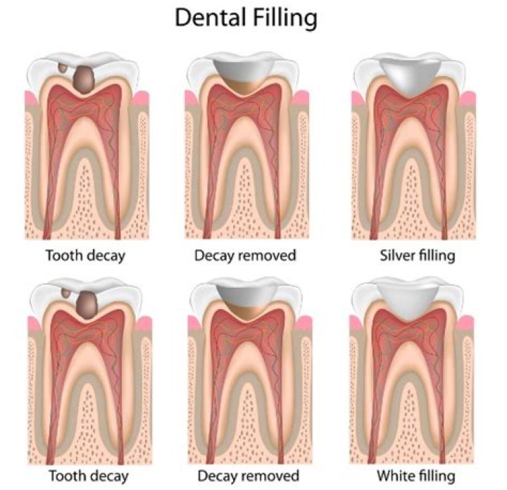 Should my filling still hurt after a week?