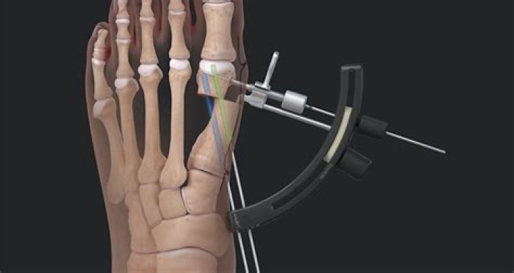 What anesthesia is used for Bunionectomy?