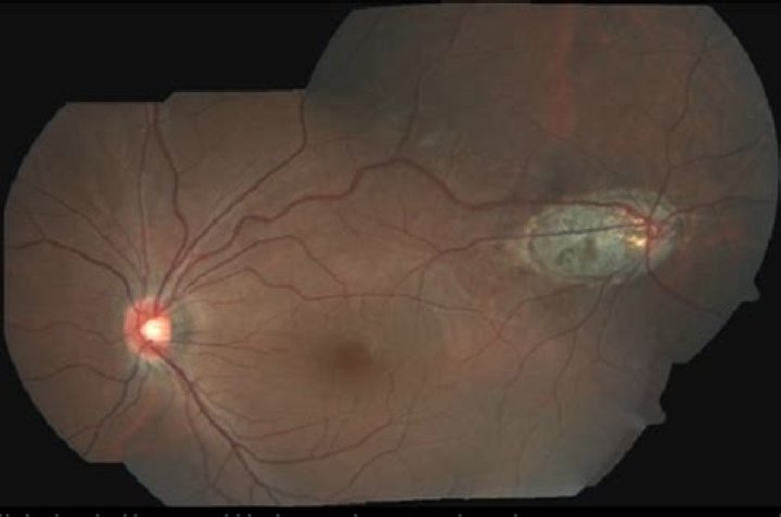 What are Chorioretinal lacunae?
