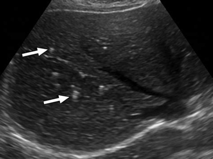 What are spots on liver ultrasound?