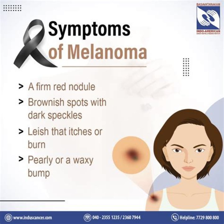What are symptoms of melanoma Besides moles?