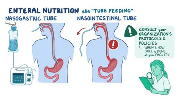What are the complications of gastrostomy feeding?