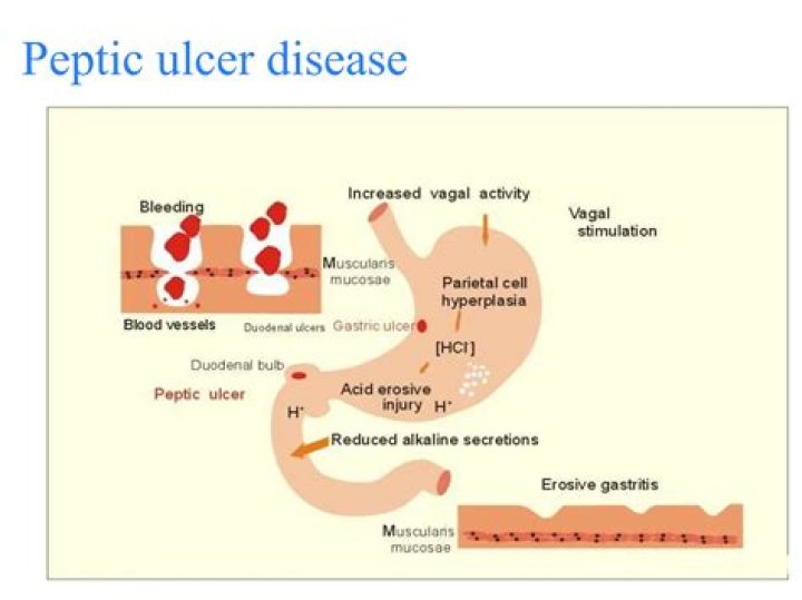 What are the main management method of peptic ulcer diseases?