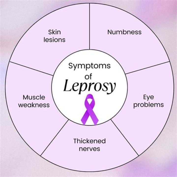 What are the side effects of MDT in leprosy?
