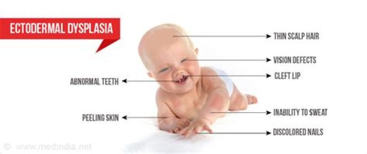 What are the symptoms of ectodermal dysplasia?