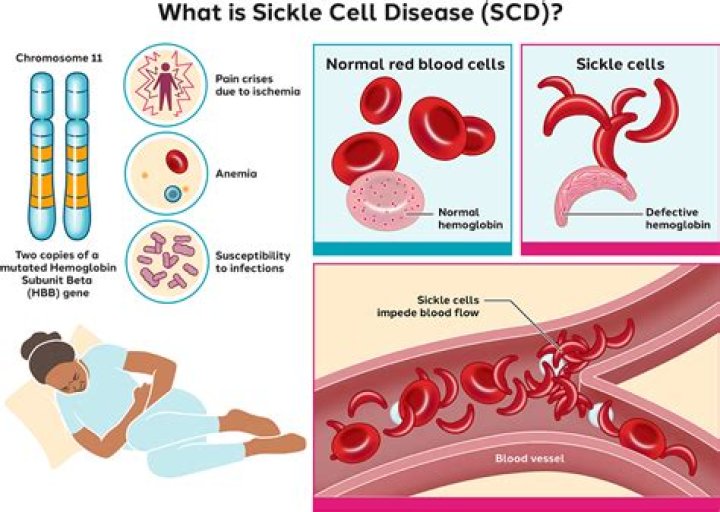 What are the three major crises of sickle cell disease?