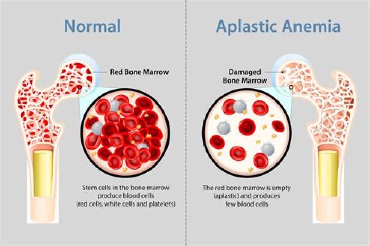 What are the two types of aplastic anemia?