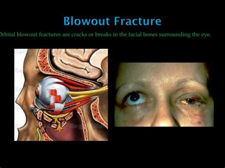 What bones are involved in a blowout fracture?