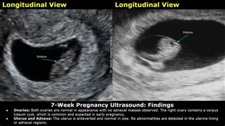 What can I expect to see at 7 week ultrasound?