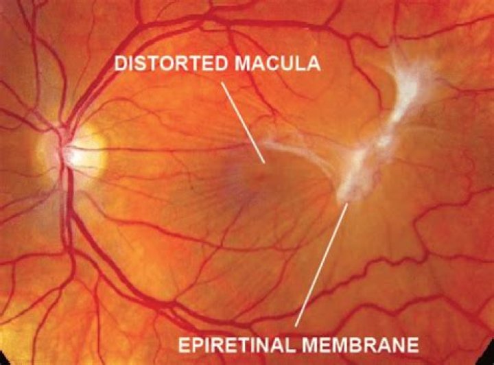 What causes an epiretinal membrane to form?