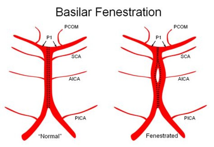 What causes basilar artery fenestration?