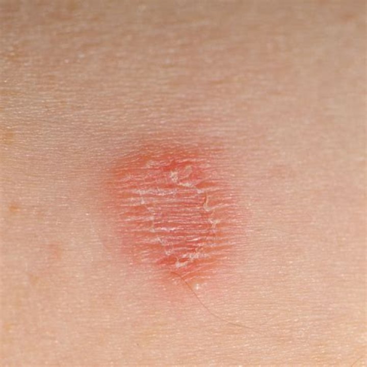What causes circular dry spots on skin?
