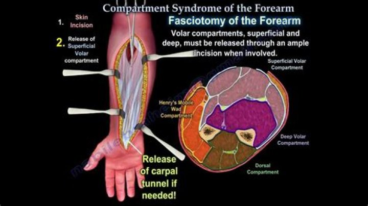 What causes compartment syndrome in the forearm?