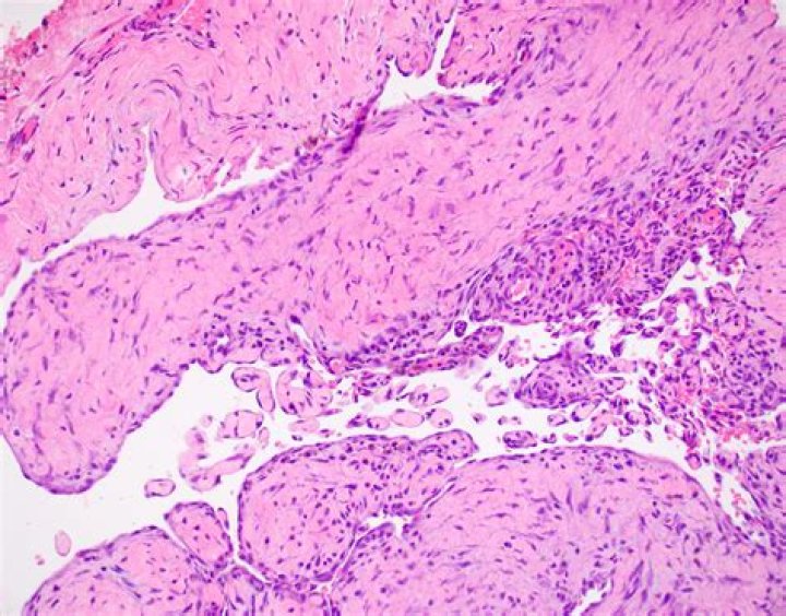 What causes Fibropapilloma?