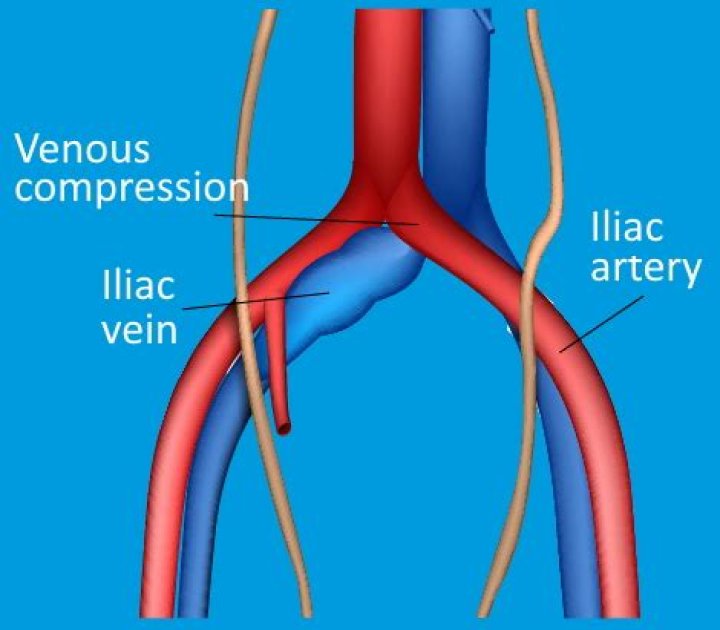 What causes iliac vein blockage?