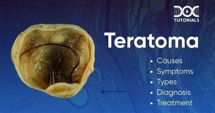 What causes immature teratoma?