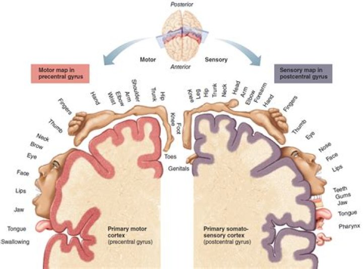 What causes infant hemiparesis?