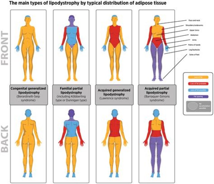 What causes lipodystrophy syndrome?