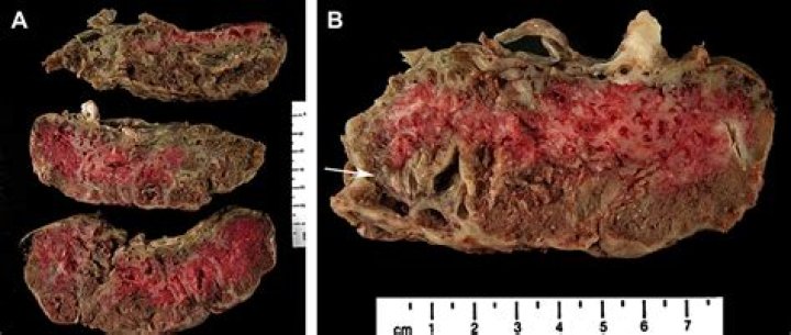 What causes maternal floor infarction?