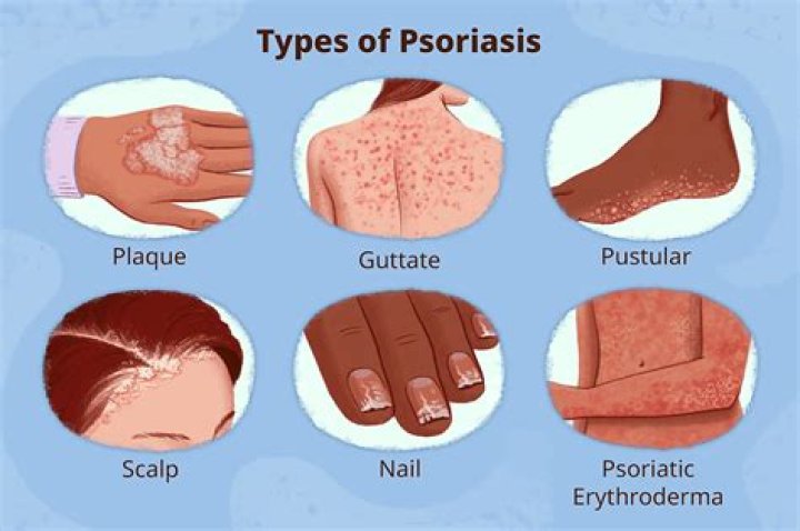 What causes psoriasis all of a sudden?