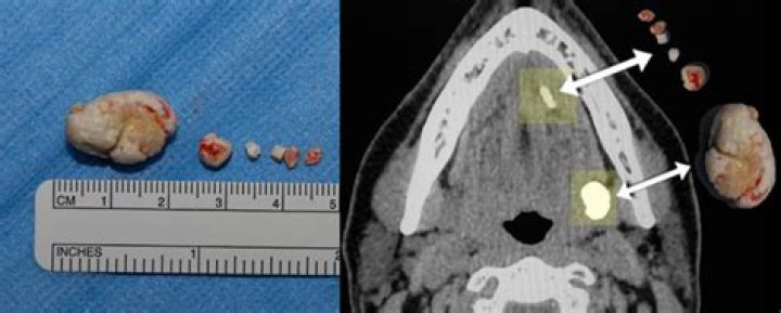 What causes salivary stones?