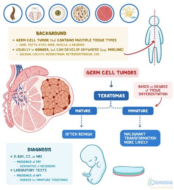 What causes teratomas?