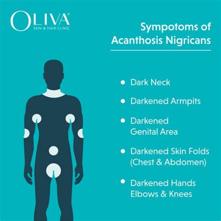 What condition is associated with acanthosis nigricans?