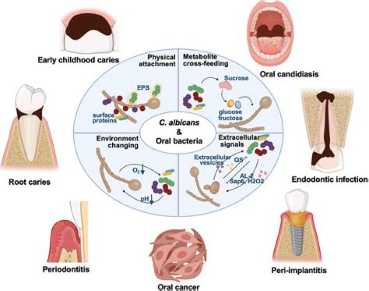 What disease is caused by Saccharomyces cerevisiae?