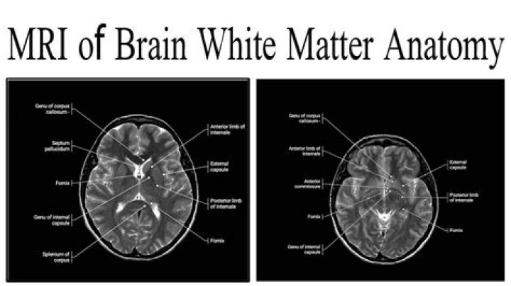 What do white lesions on the brain mean?