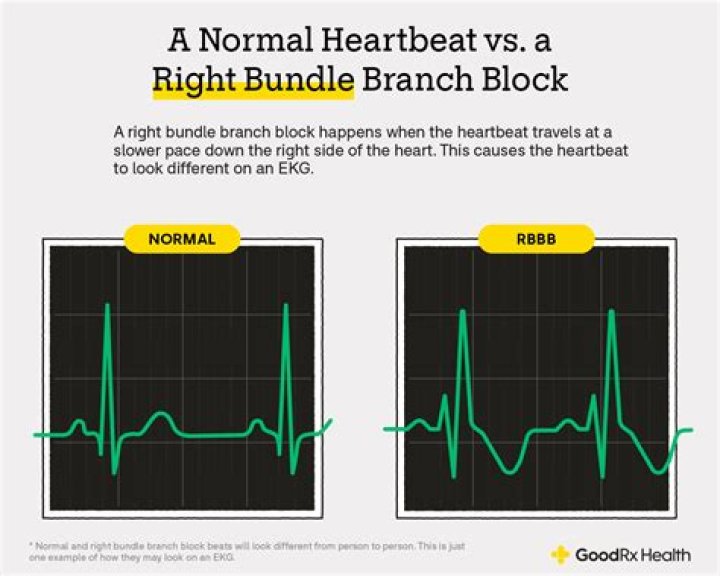 What does a bundle mean on an EKG?