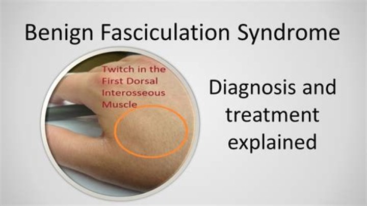 What does a fasciculation look like?