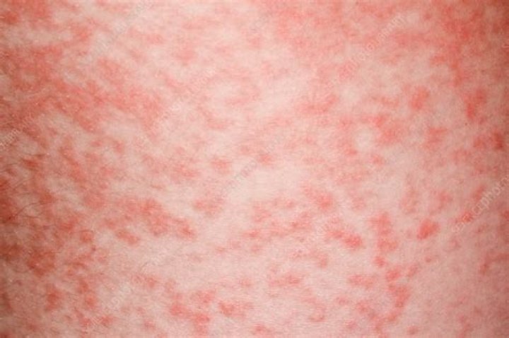 What does an antibiotic skin rash look like?