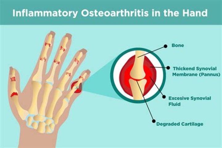 What does an arthritis bump look like?
