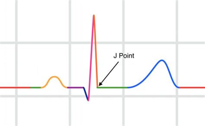 What does an elevated J-point mean?