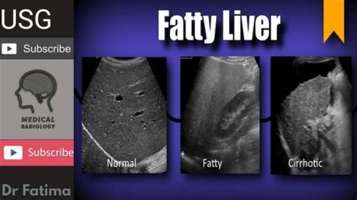 What does an enlarged liver mean in a fetus?