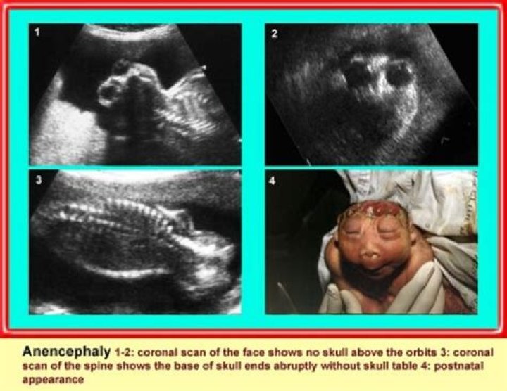 What does anencephaly look like on an ultrasound?