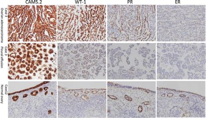 What does CAM5 2 positive mean?