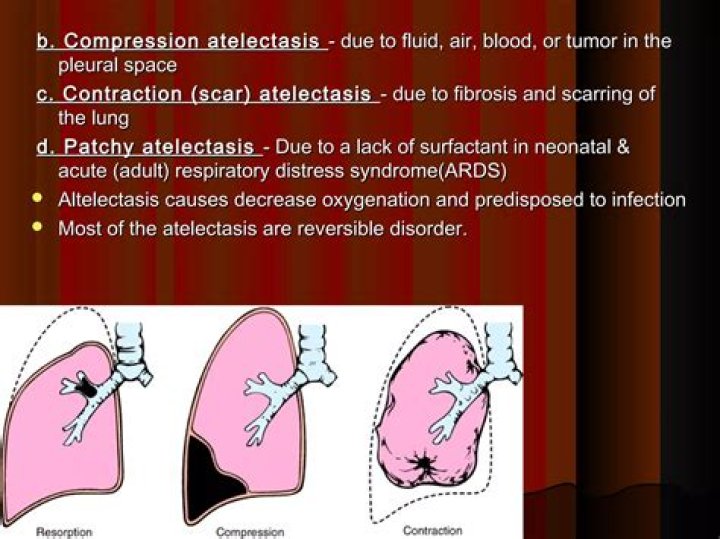 What does compressive atelectasis mean?