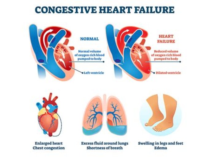 What does congestive heart failure look like on an xray?
