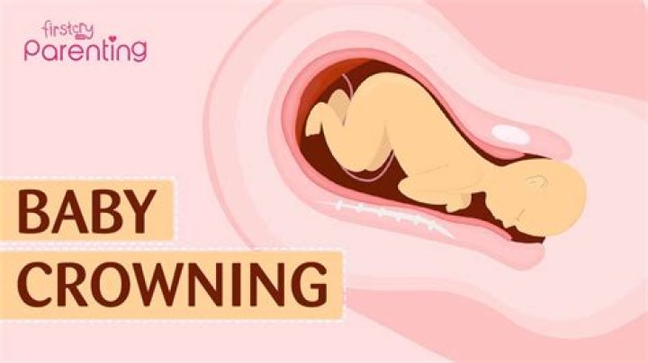 What does crowning mean in childbirth?