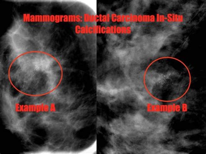 What does DCIS look like on mammogram?