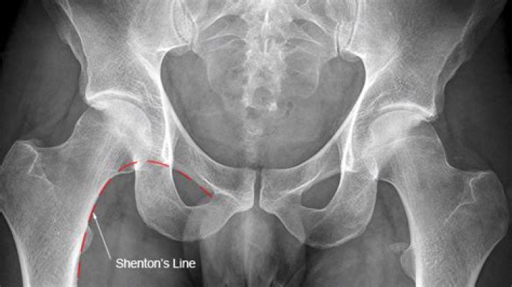 What does hip and pelvis X-ray show?