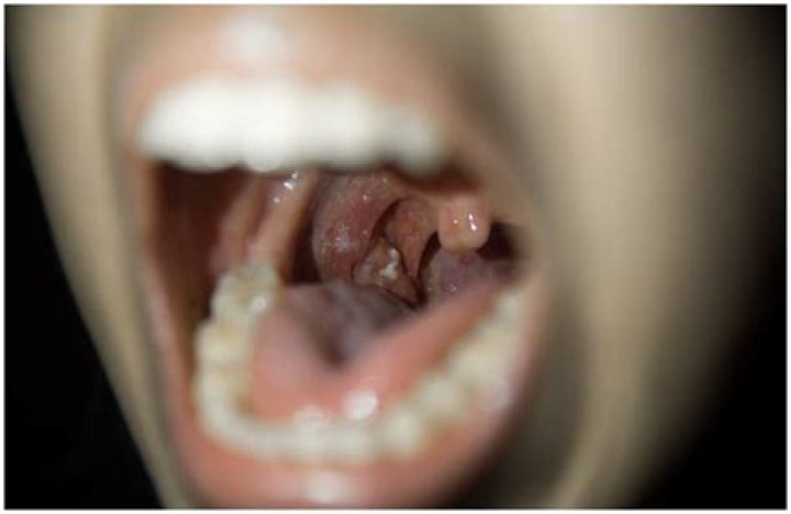What does it mean when your tonsils are cryptic?