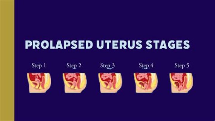 What does it mean when your uterus is backwards?