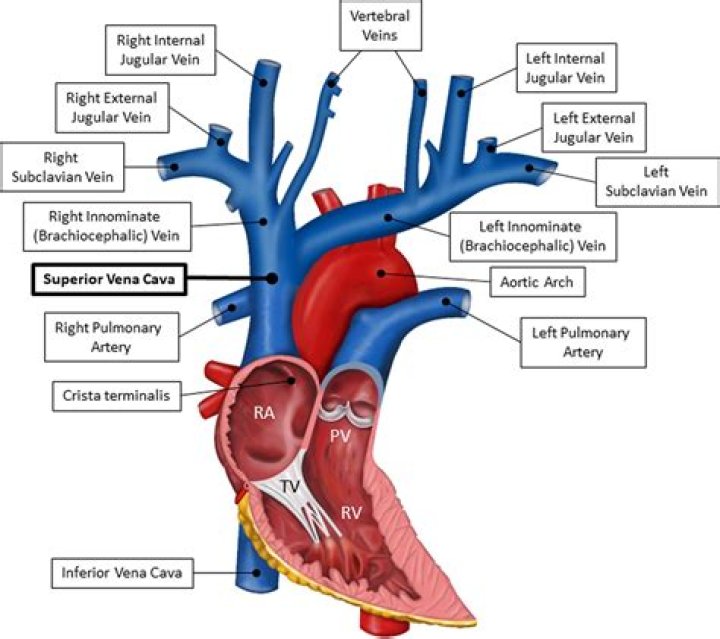 What does persistent left superior vena cava mean?