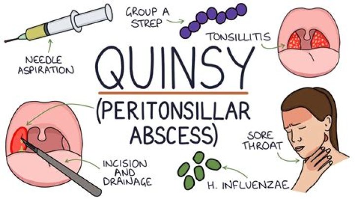 What does quinsy look like?