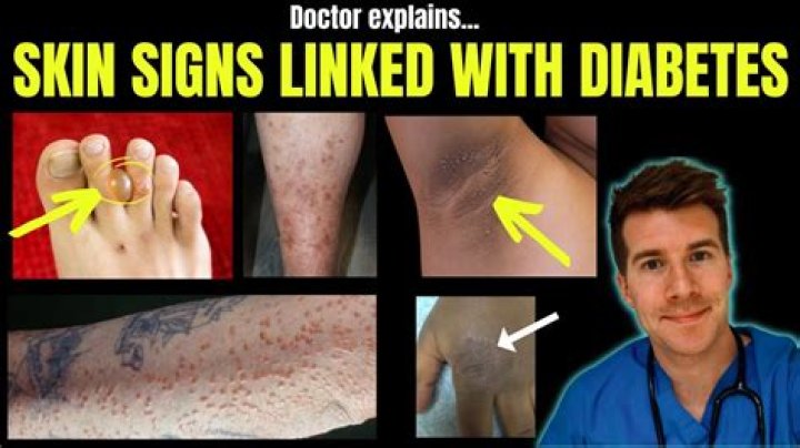 What does the skin of a diabetic look like?
