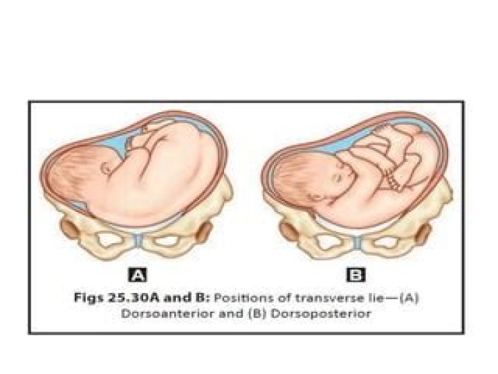 What does transverse lie mean?